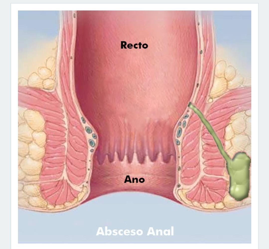 Tratamiento de pólipos y abscesos anorrectales en Ciudad Obregón - Dra. Nancy Olivas
