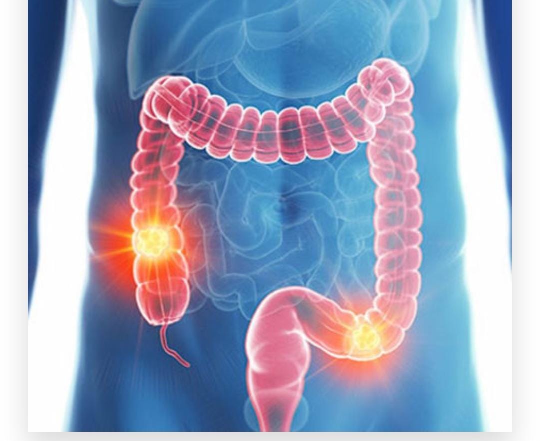 Detección y tratamiento de cáncer colorrectal en Ciudad Obregón - Dra. Nancy Olivas